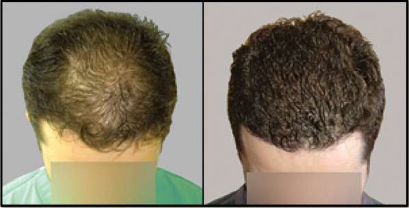 Providence Hair Restoration Center | 1 Randall Square #405, Providence, RI 02904, USA | Phone: (401) 521-0303