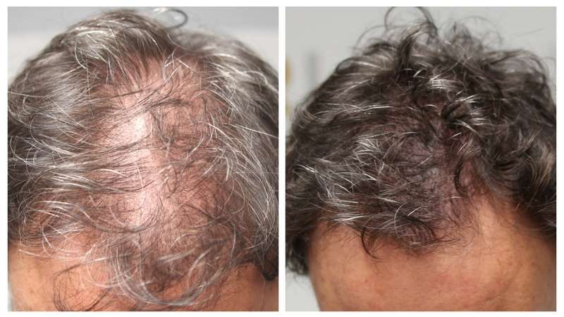 Scalp Micropigmentation • Hair Tattoo Salon | 211 TX-121 Suite #120-A, Lewisville, TX 75067, USA | Phone: (972) 839-1999