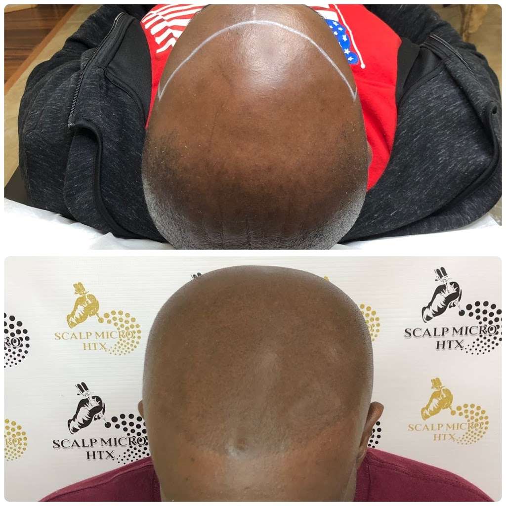 Scalp Micro HTX | 6510 Bellfort St C, Houston, TX 77087, USA | Phone: (832) 303-1722