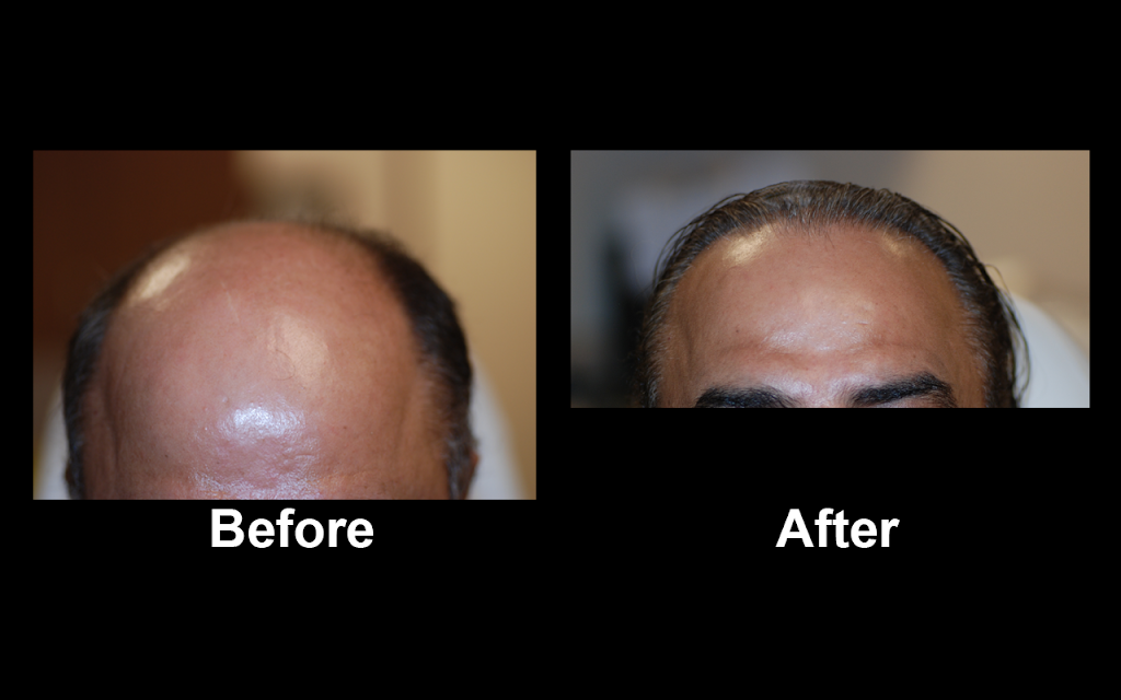 Halby Hair Transplant, Ltd. | 5524 S Fort Apache Rd Suite #100, Las Vegas, NV 89148, USA | Phone: (702) 258-6229