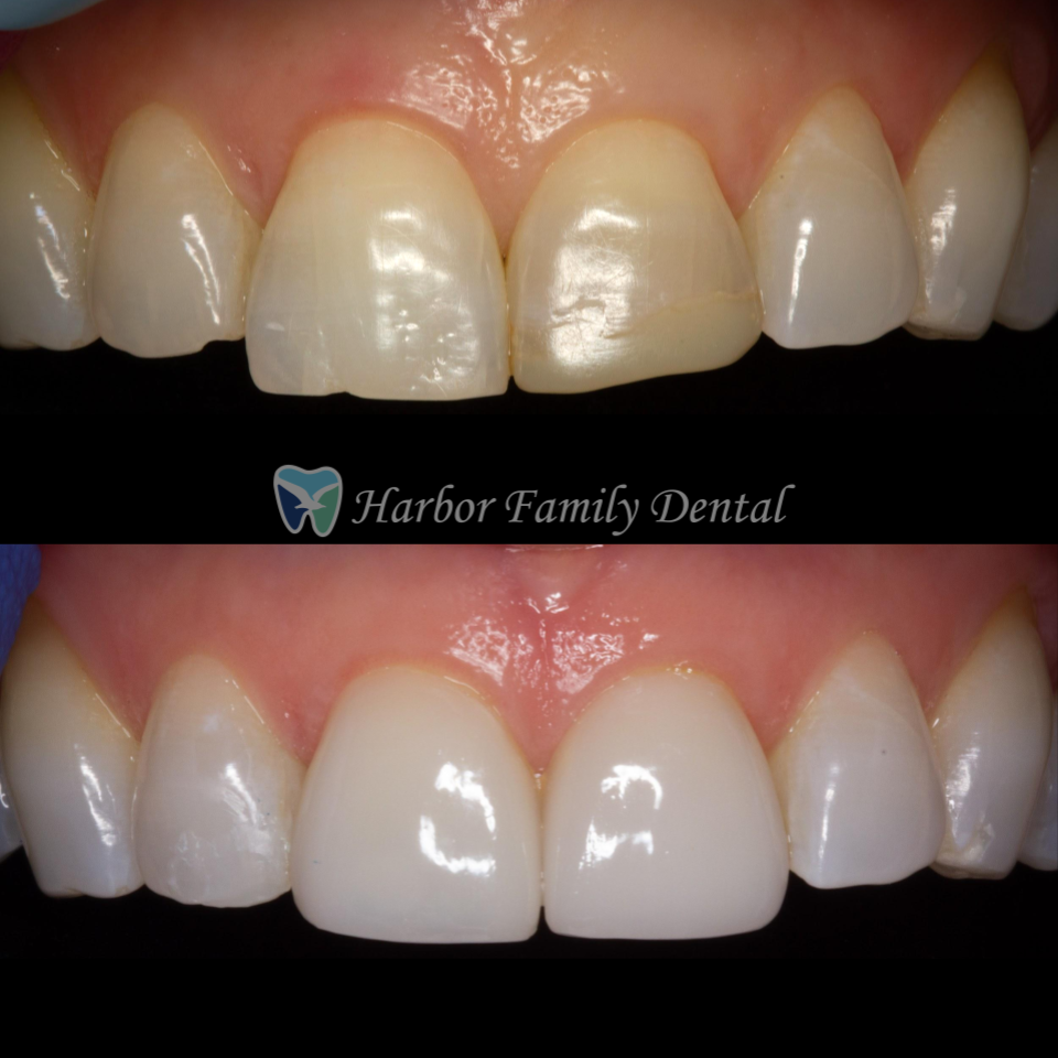 Harbor Family Dental | 1310 Rosecrans St Ste B, San Diego, CA 92106, USA | Phone: (619) 786-2939
