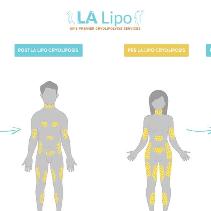 LA Lipo Radlett | 349 Watling St, Radlett WD7 7LB, UK | Phone: 01923 553038