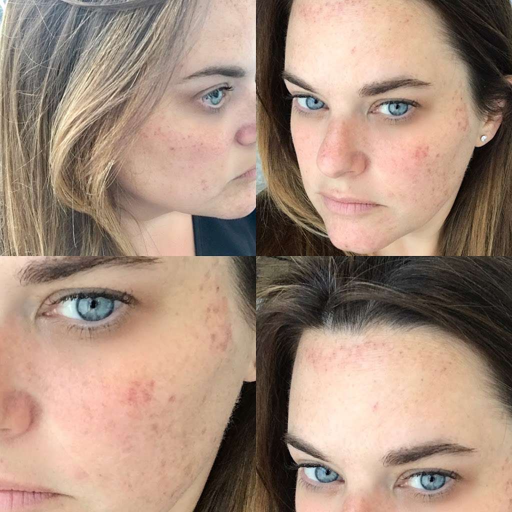 Indigo Aesthetics & Laser Clinic | 3100 SW 7 Highway, Suite A, Blue Springs, MO 64014, USA | Phone: (816) 598-5331