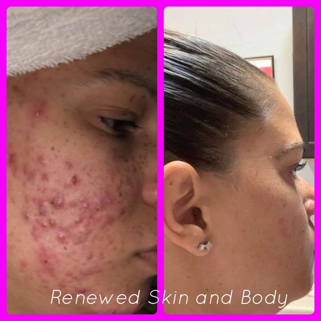 Renewed Skin & Body | 5930 W Greenway Rd Ste 18C, Glendale, AZ 85306, USA | Phone: (623) 469-5770