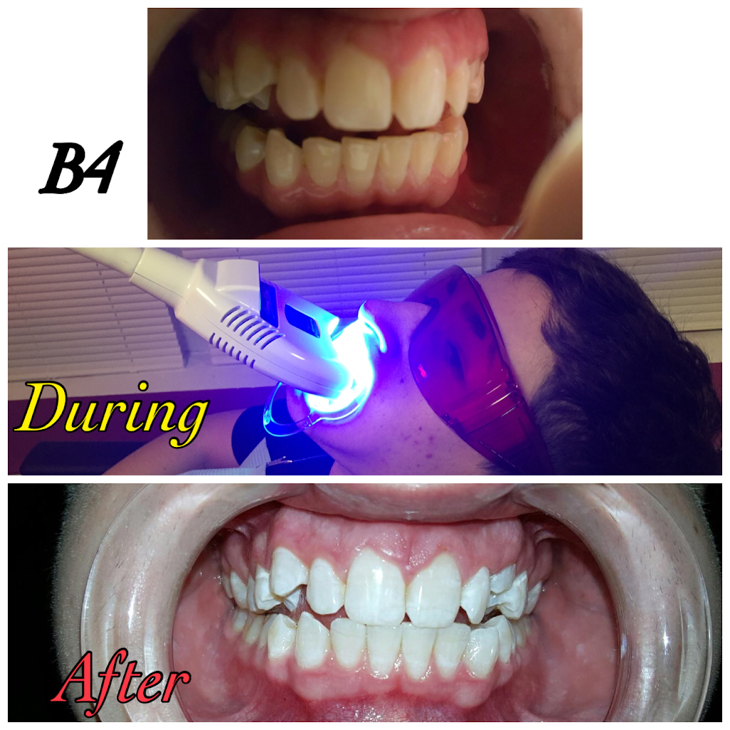 Teeth whitening beauty services | 100 W West Dr, Northlake, IL 60164 | Phone: (708) 890-1176