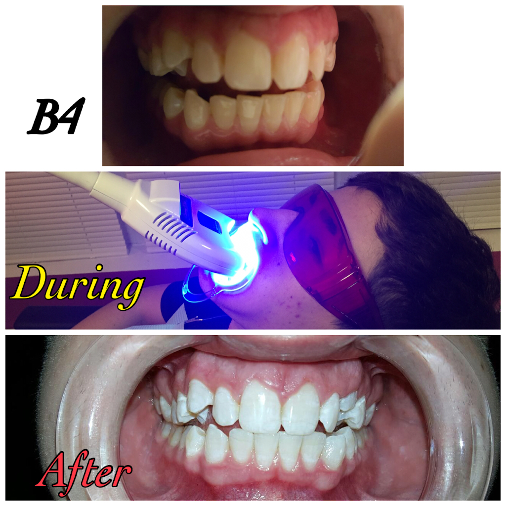 Teeth whitening beauty services | 100 W West Dr, Northlake, IL 60164, USA | Phone: (708) 890-1176