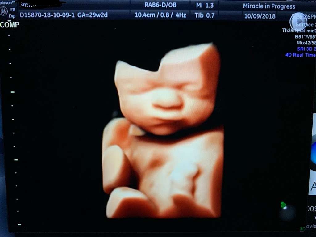 Miracle In Progress 3D/4D Ultrasound Studio - Early Gender Deter | 211 Windsor Rd, Mullica Hill, NJ 08062, USA | Phone: (609) 578-7923