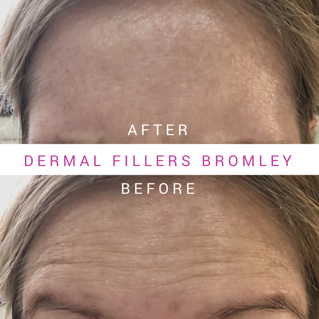 Dermal Fillers Bromley | Westbury Rd, Bromley BR1 2QB, UK | Phone: 07740 088563