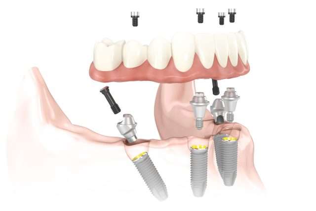 The Dental Method Richardson | 610 Old Campbell Rd #116, Richardson, TX 75080, USA | Phone: (972) 231-2576