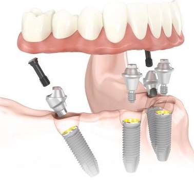 Implants & Periodontal Arts - Endo Arts | 3800 W Ray Rd Suite B-6, Chandler, AZ 85226, USA | Phone: (480) 963-2787