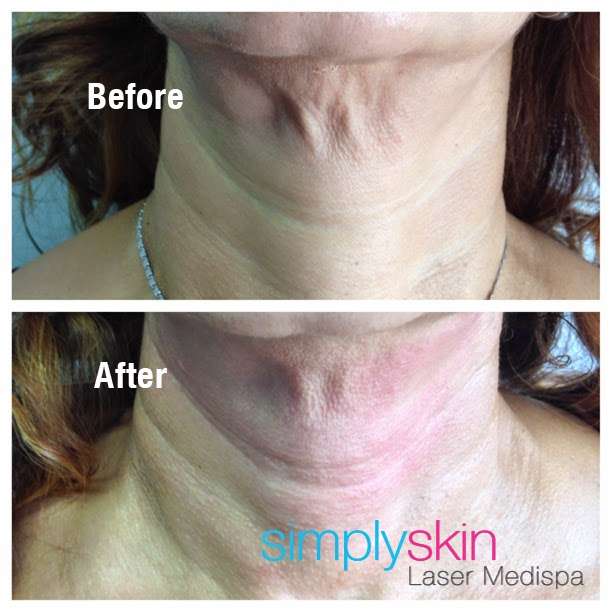 Simply Skin Laser Medispa | 880 Mile Square Rd, Yonkers, NY 10704, USA | Phone: (914) 374-6914