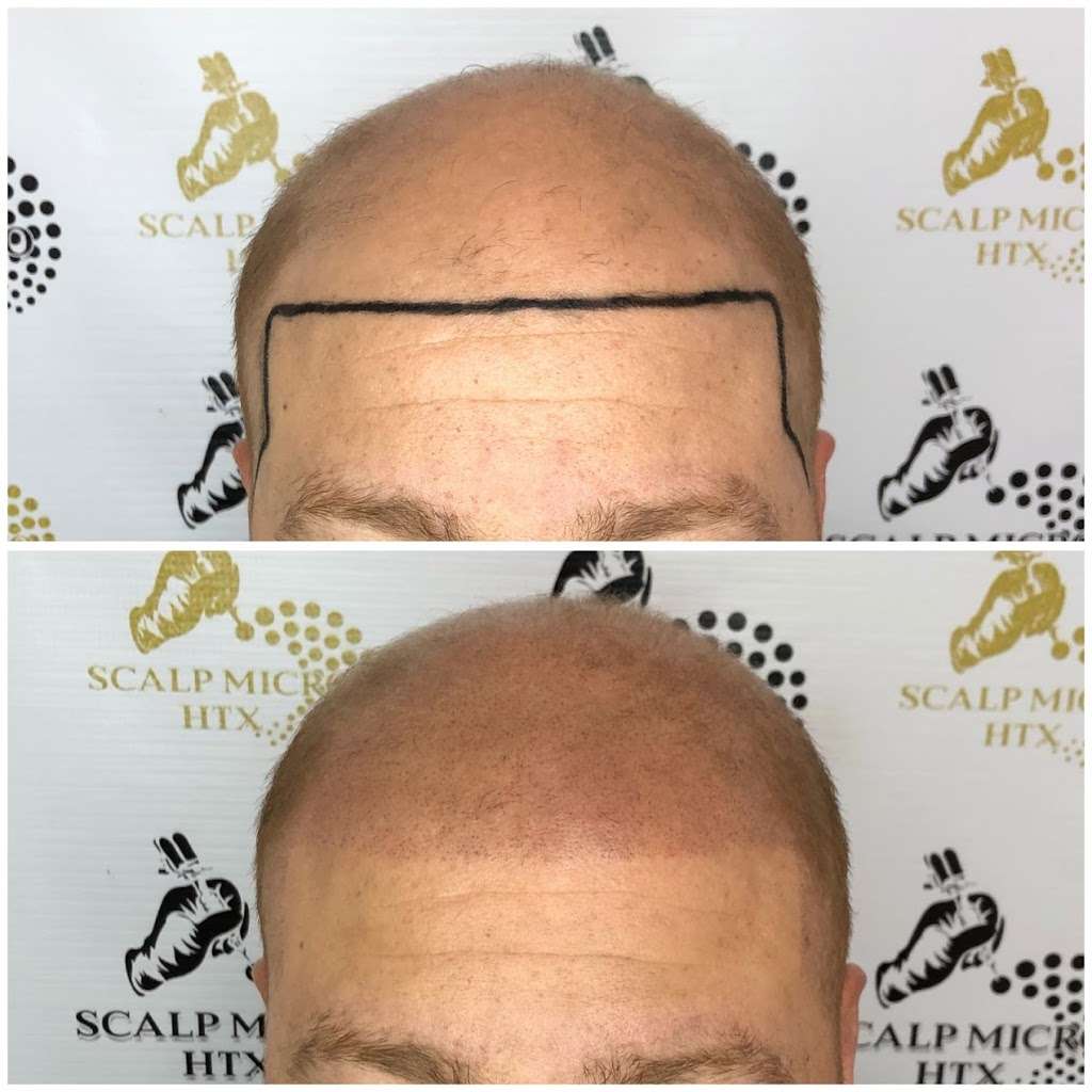 Scalp Micro HTX | 6510 Bellfort St C, Houston, TX 77087, USA | Phone: (832) 303-1722