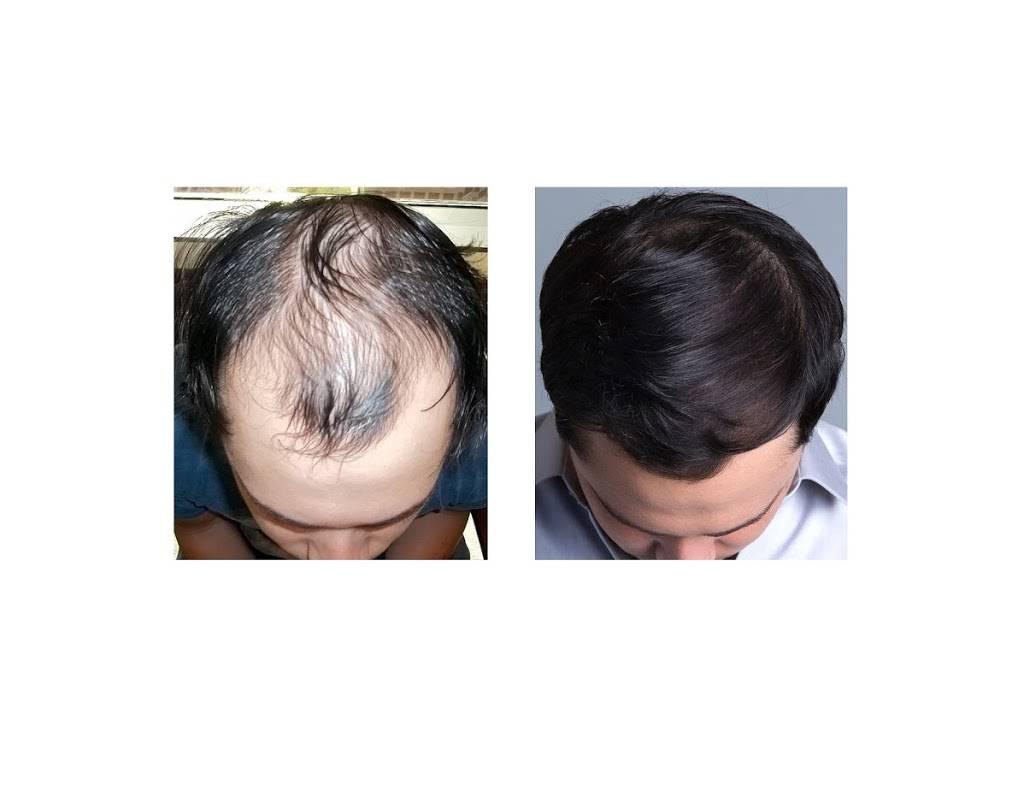 Bosley - Hair Restoration & Transplant | 1860 Howe Ave #230, Sacramento, CA 95825, USA | Phone: (916) 209-0774