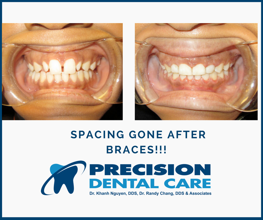 Precision Dental Care | 5745 W Belmont Ave, Chicago, IL 60634, USA | Phone: (773) 622-2642