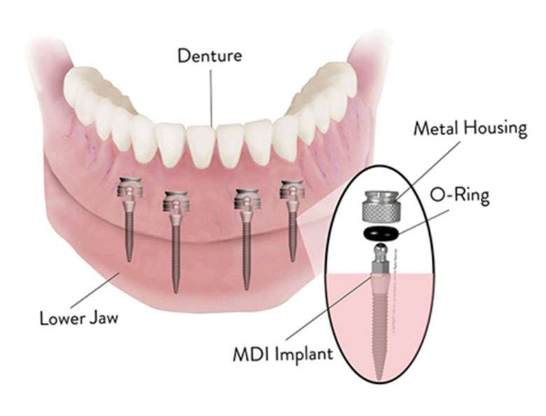 Mini Dental Implant Solutions | 931 Hamburg Turnpike #1, Wayne, NJ 07470, USA | Phone: (973) 221-3303