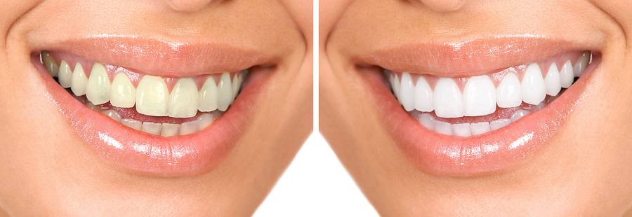 JP Teeth Whitening Service | 595 Estudillo Ave Site C, San Leandro, CA 94577, USA | Phone: (510) 567-3591