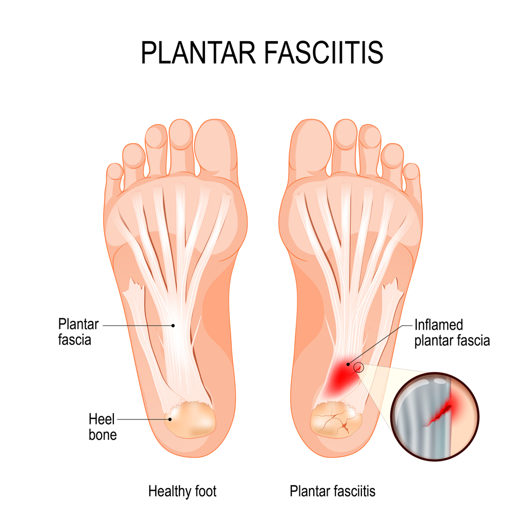 Foot Pain Therapy | 220A St Nicholas Ave, Brooklyn, NY 11237, USA | Phone: (323) 486-6008