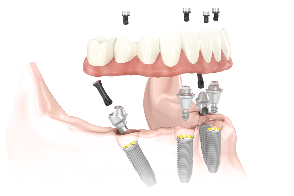 Nobel Biocare USA, LLC | 22715 Savi Ranch Pkwy, Yorba Linda, CA 92887, USA | Phone: (714) 282-4800