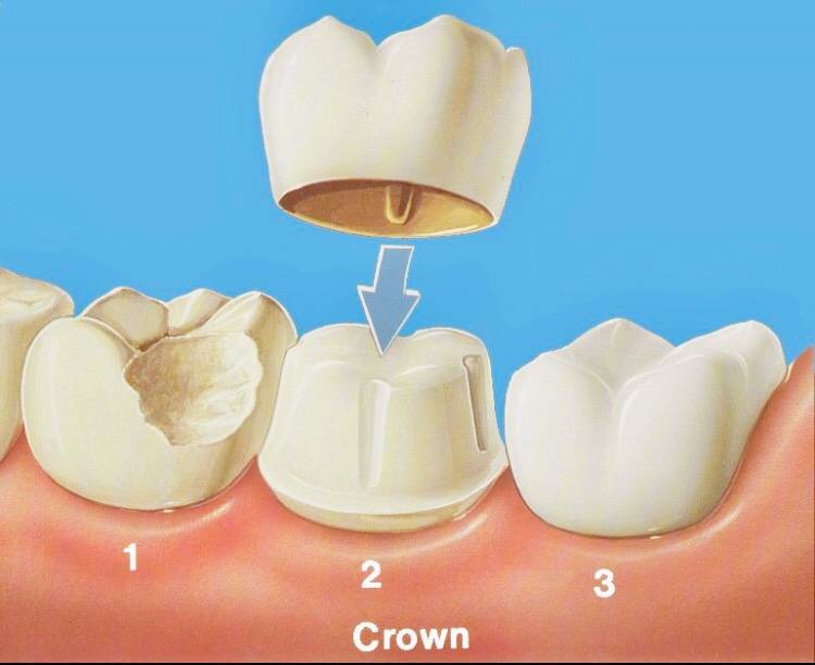 Santa Ana Magic Smile - Dr. Bhaswati Moulik, Dentist Santa Ana 9 | 2112 N Main St #100, Santa Ana, CA 92706 | Phone: (714) 835-6677