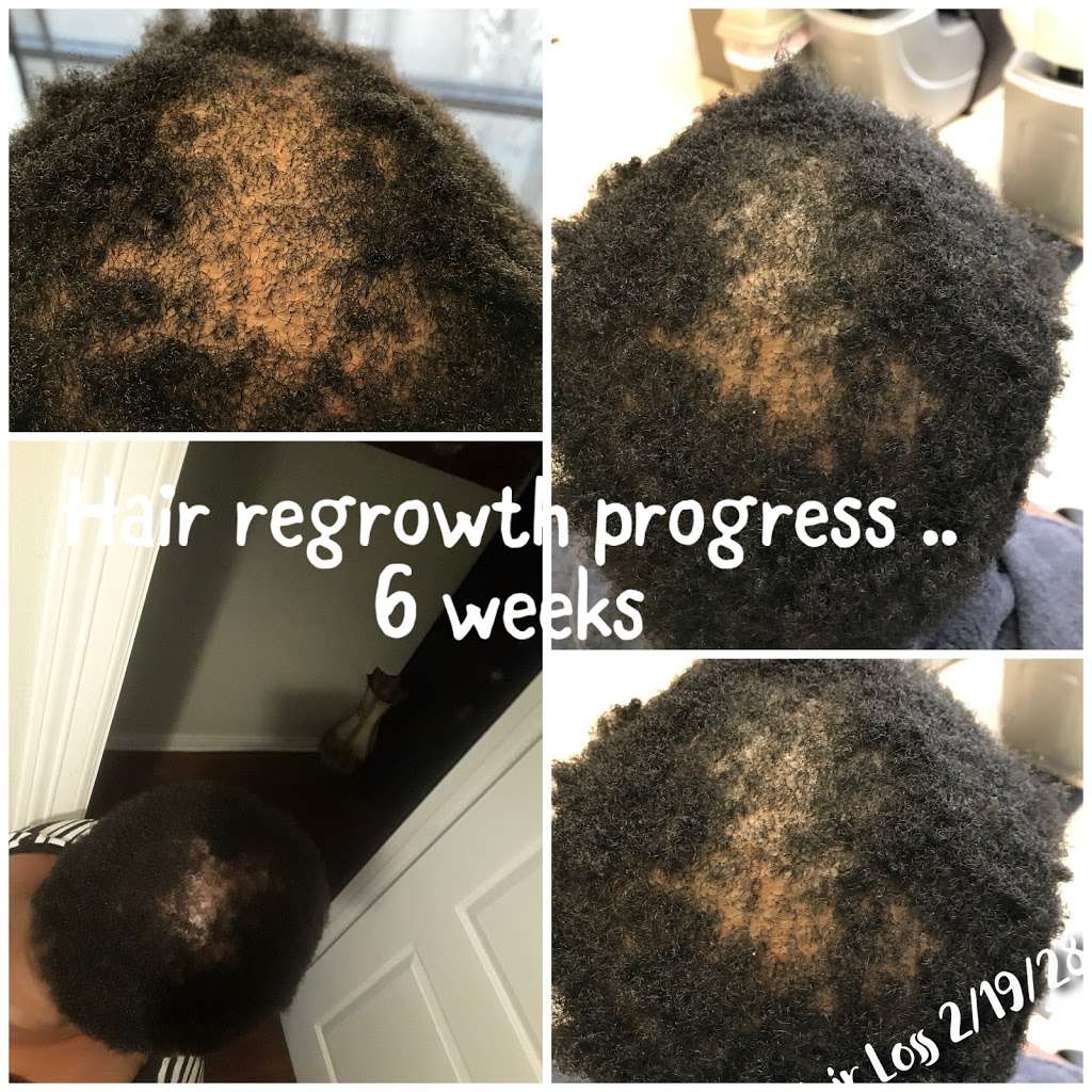 Restore Hair Now | 1910 Country Pl Blvd suite 156, Pearland, TX 77584 | Phone: (281) 968-9155