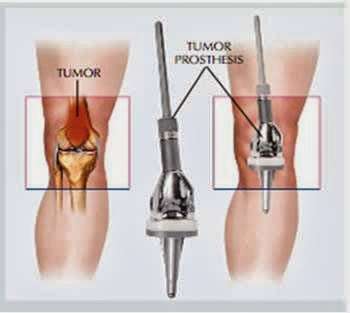 Sarcoma Specialists | 1625 N George Mason Dr #464, Arlington, VA 22205 | Phone: (703) 717-4670