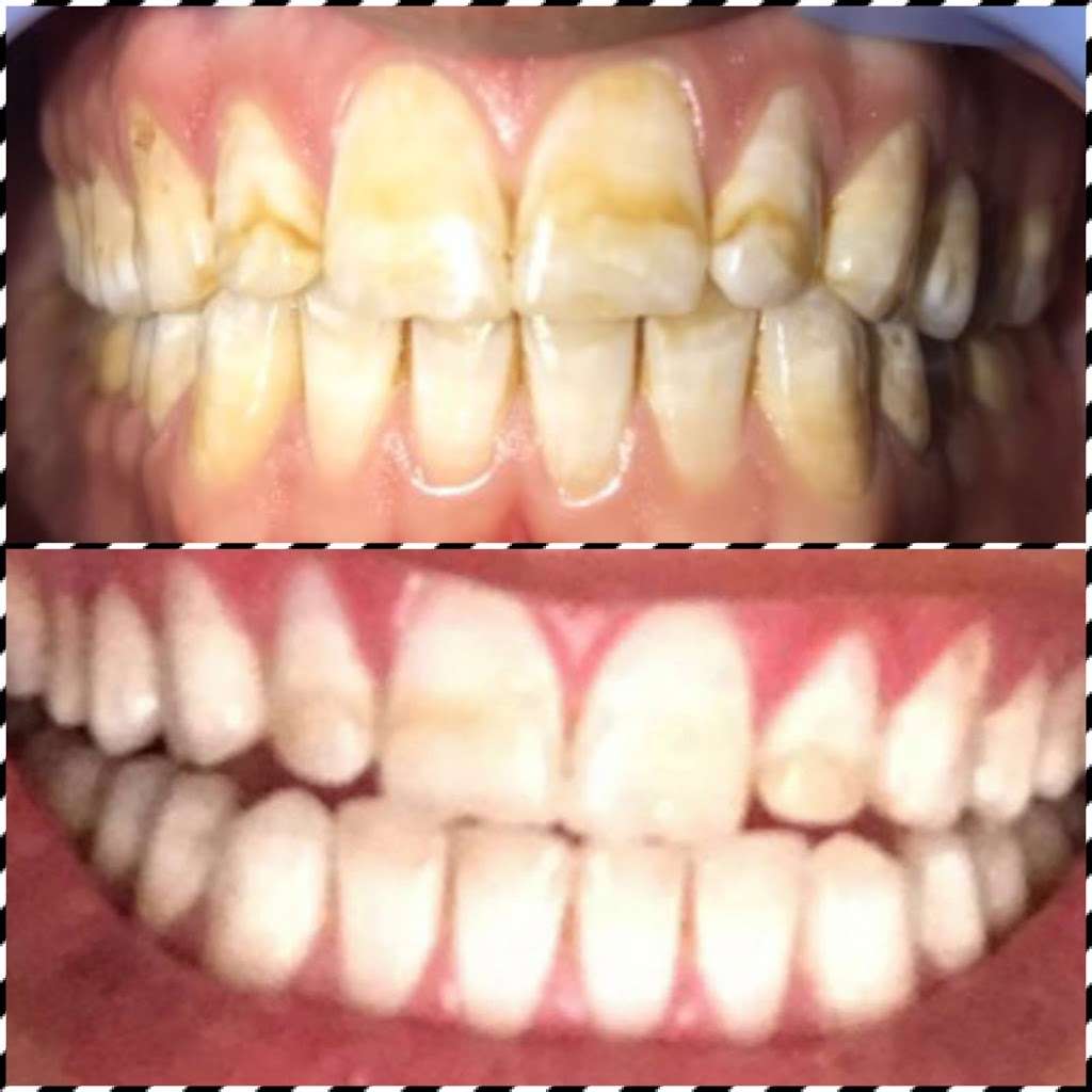 Yevonne’s laser teeth whitening LLC | 4933 S Carson St APT 212, Aurora, CO 80015, USA | Phone: (720) 629-9030