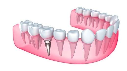 Dr Naser Sharifi Implant Dentistry | 25315 80th Ave Ste 1, Queens, NY 11004, USA | Phone: (718) 470-9000