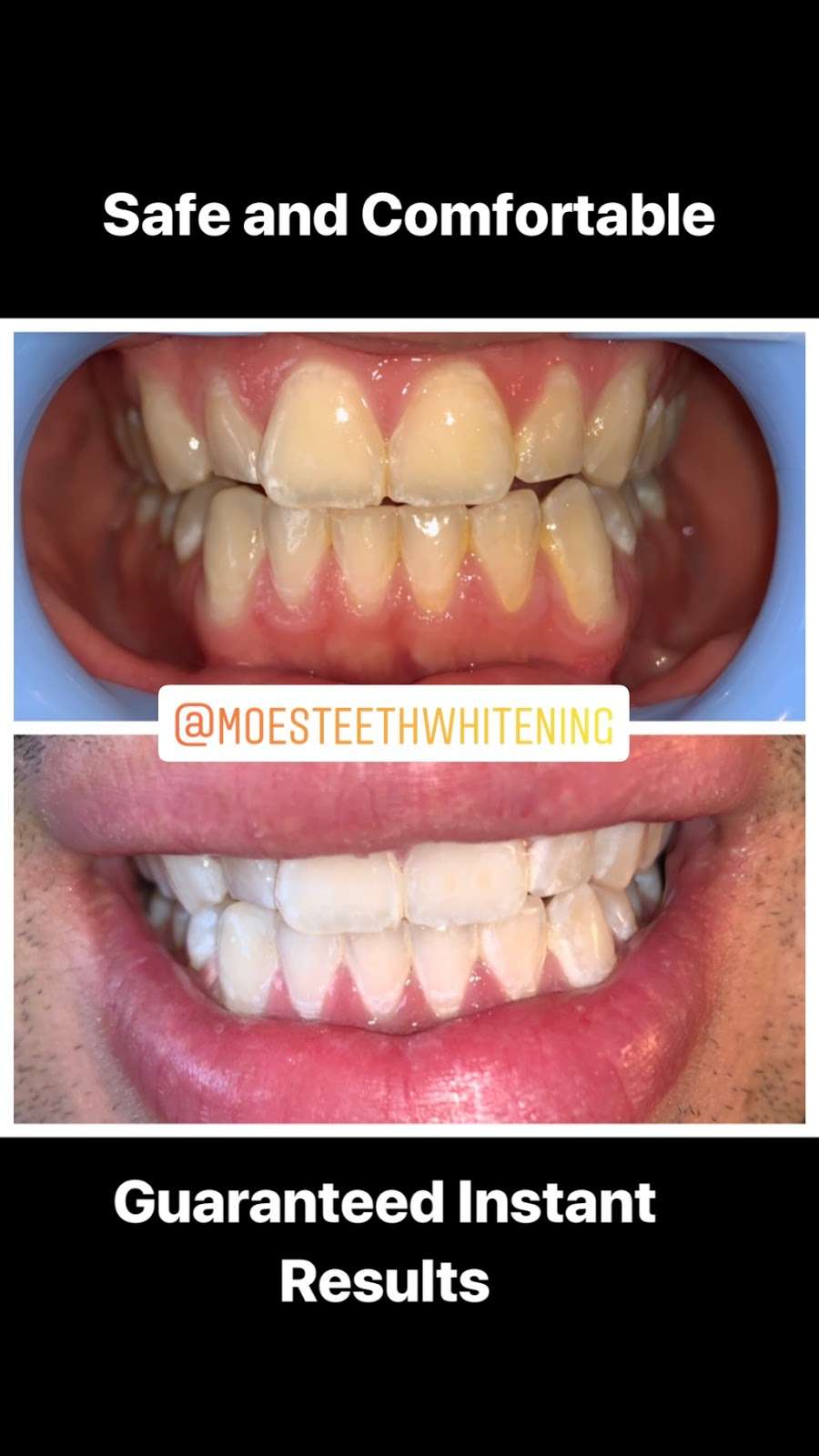 Moes Teeth Whitening | 1530 Jamacha Rd. #X, El Cajon, CA 92019, USA | Phone: (619) 922-1280