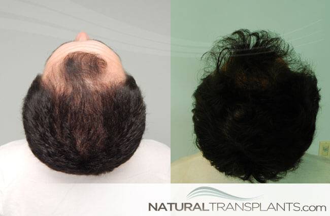 Natural Transplants, Hair Restoration Clinic | 1228 E 7th Ave #200, Tampa, FL 33605 | Phone: (813) 440-2598