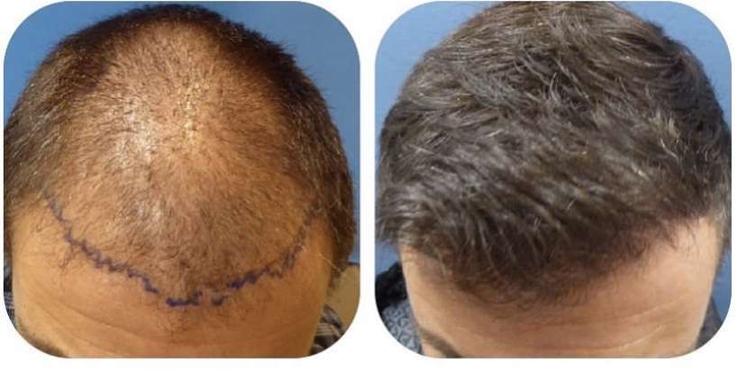 Meshkin Medical - Cosmetic Hair Restoration and Hair Transplant  | 912 W Glenoaks Blvd, Glendale, CA 91202, USA | Phone: (800) 246-8424