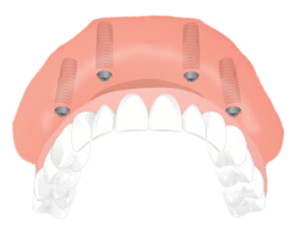 Dental Implant Solutions Plano, IL | 901 US-34 #103A, Plano, IL 60545 | Phone: (630) 425-2809
