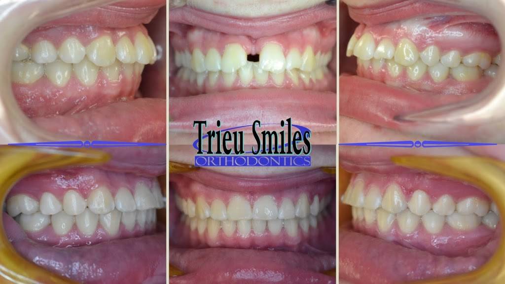 Trieu Smiles Orthodontics | 3708 4th St #103, Harvey, LA 70058 | Phone: (504) 309-7830