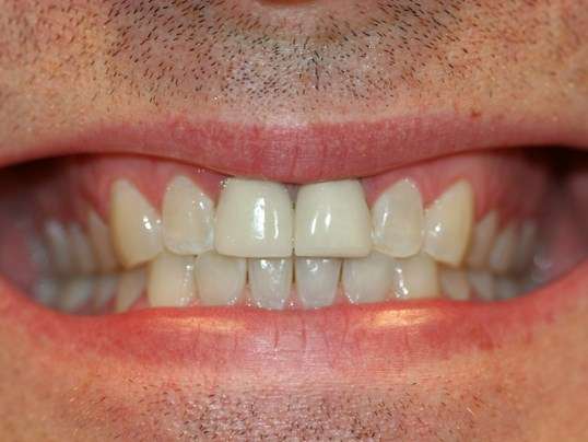 Martin Dentistry | 13760 Lakeridge Dr, Fishers, IN 46037 | Phone: (317) 863-5077