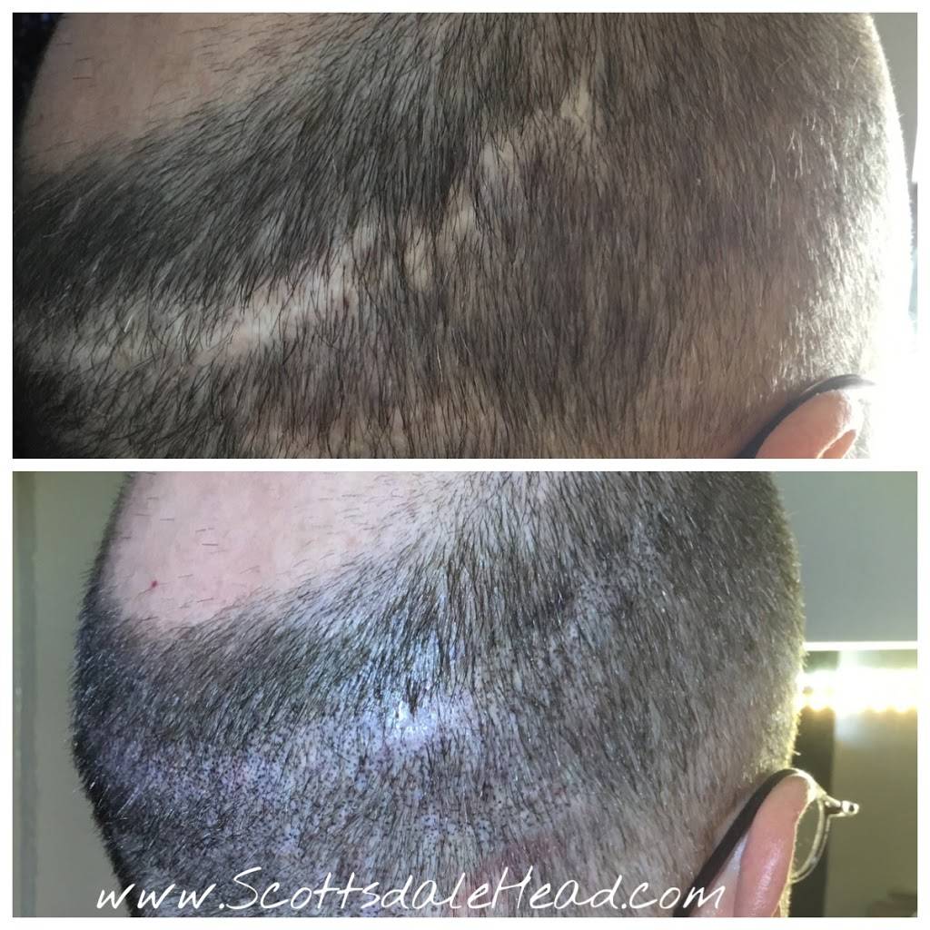 Scottsdale Hairlines Scalp MicroPigmentation Hairloss Clinic | 3295 N Drinkwater Blvd Suite 16, Scottsdale, AZ 85251, USA | Phone: (602) 680-0008