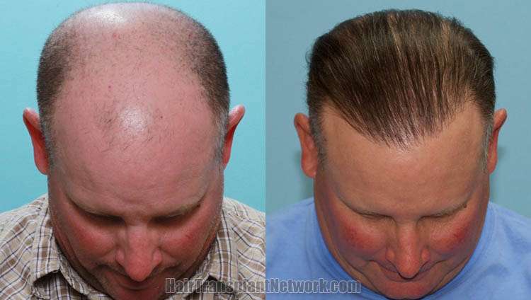 Carolina Hair Surgery: FUE Hair Transplant | 1021 Maxwell Mill Rd, Fort Mill, SC 29708, USA | Phone: (803) 217-3065