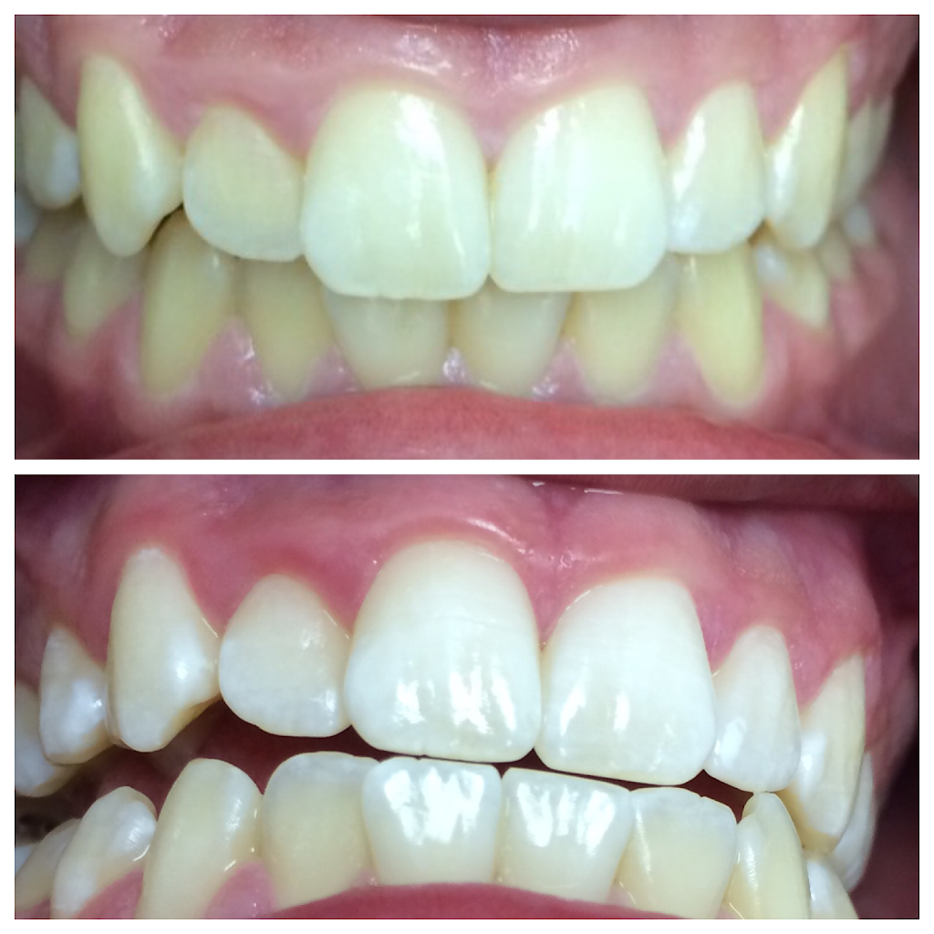 Lumin Teeth Whitening | 12841 Jones Rd #208, Houston, TX 77070, USA | Phone: (281) 463-4601