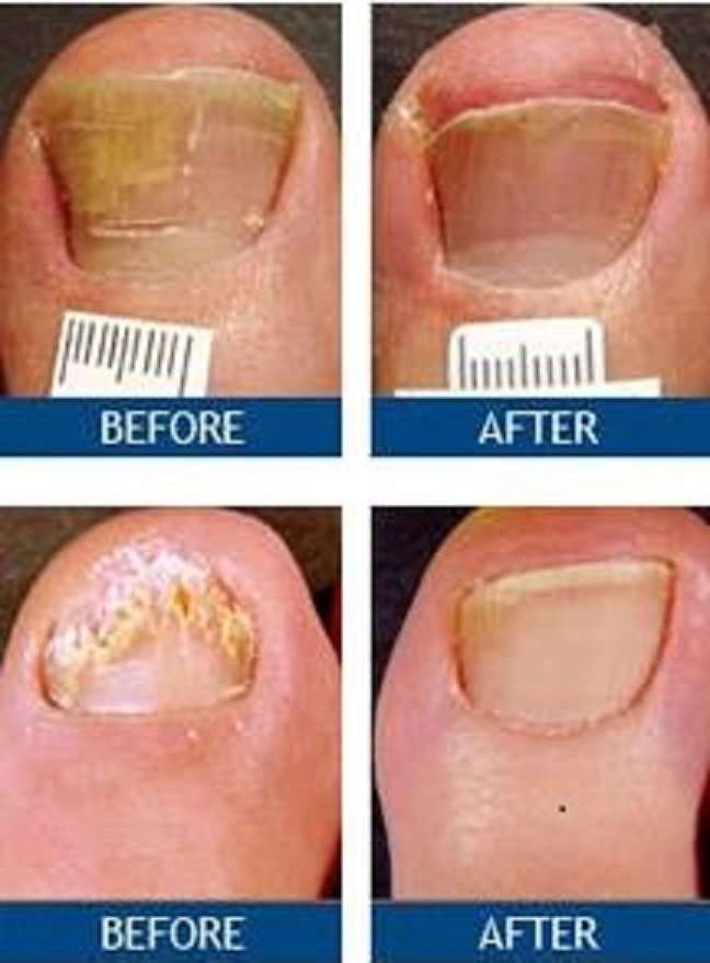 Laser Nail Therapy- Largest Toenail Fungus Treatment Center | 8575 E Princess Dr #221, Scottsdale, AZ 85255 | Phone: (800) 672-0625