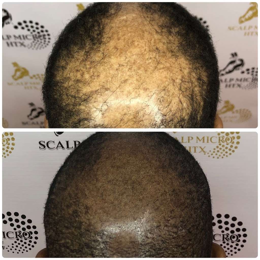 Scalp Micro HTX | 6510 Bellfort St C, Houston, TX 77087, USA | Phone: (832) 303-1722