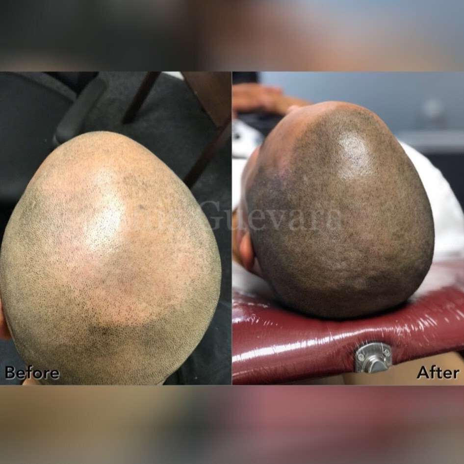 Modern Eclipse Scalp Micropigmentation | 5366 N Elston Ave Ste. 207, Chicago, IL 60630, USA | Phone: (773) 828-9421