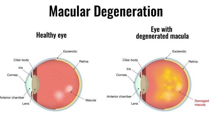 Cataract and Eye Consultants of Michigan | 29753 Hoover Rd Ste. A, Warren, MI 48093, USA | Phone: (586) 573-4333