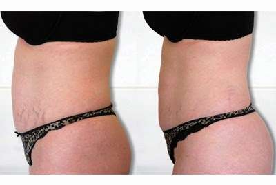 Body by Sage Laser Lipo | 1220 Illicks Mill Rd, Bethlehem, PA 18017 | Phone: (610) 865-9961