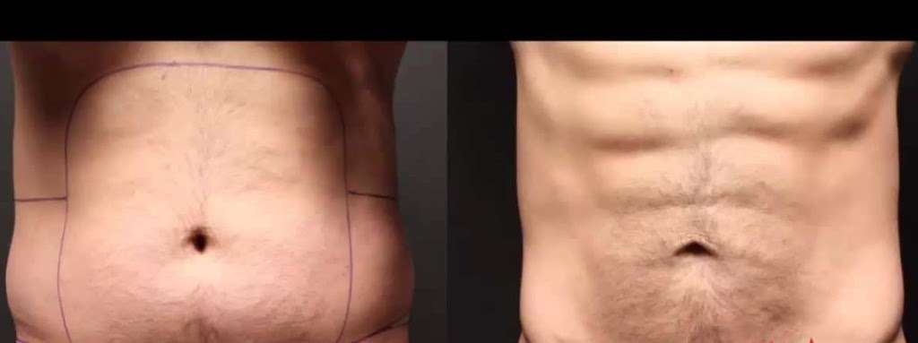 Cold Sculpting Body Contouring | 6670 S Tenaya Way Suite 140, Las Vegas, NV 89113, USA | Phone: (702) 448-0237