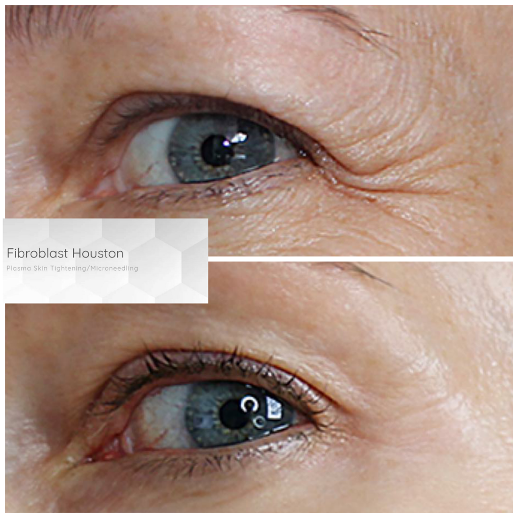 Fibroblast Houston | 18096 Kings Row # C, Houston, TX 77058, USA | Phone: (713) 614-3485