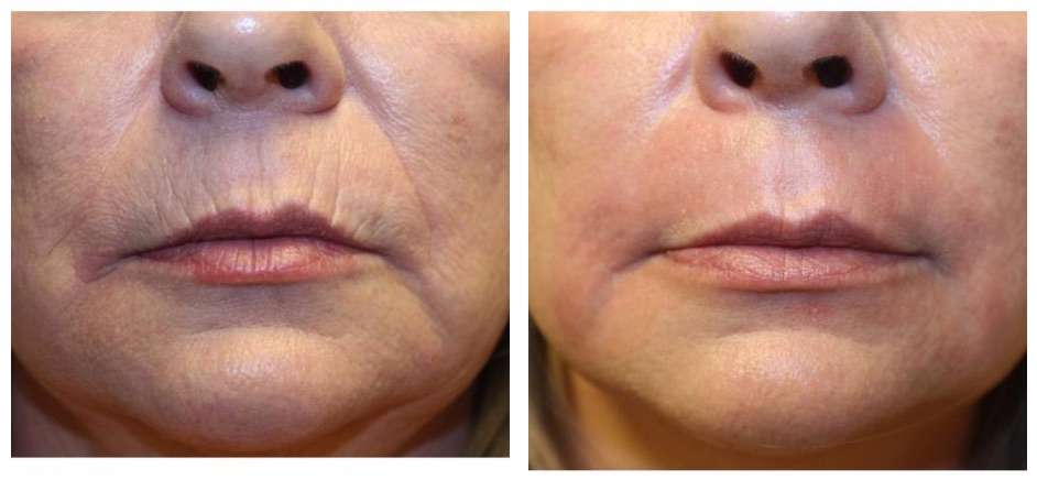 Plasma Skin Lifting NY | 5625 Post Rd #1, The Bronx, NY 10471, USA | Phone: (646) 377-0448