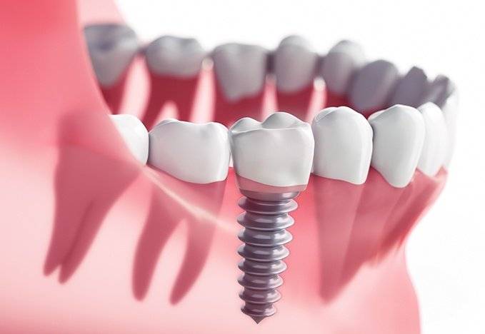 Tooth Implant Brooklyn | 2384 Ocean Ave suite 170, Brooklyn, NY 11229 | Phone: (718) 701-6433
