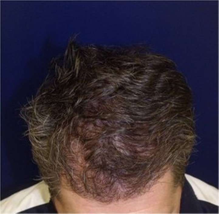 Chesapeake Hair Restoration - Hair Transplants in Baltimore, Mar | 10807 Falls Rd #101, Lutherville-Timonium, MD 21093, USA | Phone: (410) 753-8600