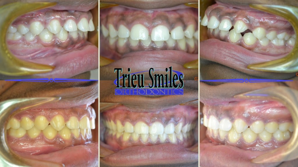 Trieu Smiles Orthodontics | 3708 4th St #103, Harvey, LA 70058 | Phone: (504) 309-7830