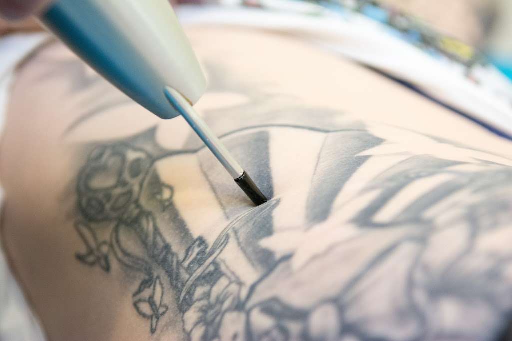 The Avalon Laser Clinic | 1 Chislehurst Rd, Orpington BR6 0DF, UK | Phone: 01689 837546