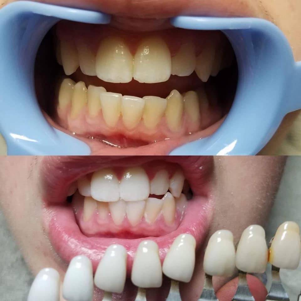 Tempe Teeth Whitening | 1969 E Broadway Rd #3, Tempe, AZ 85282, USA | Phone: (480) 823-6548