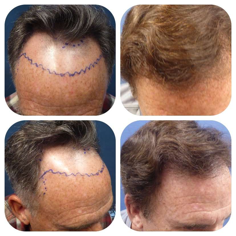 Meshkin Medical - Cosmetic Hair Restoration and Hair Transplant  | 912 W Glenoaks Blvd, Glendale, CA 91202, USA | Phone: (800) 246-8424